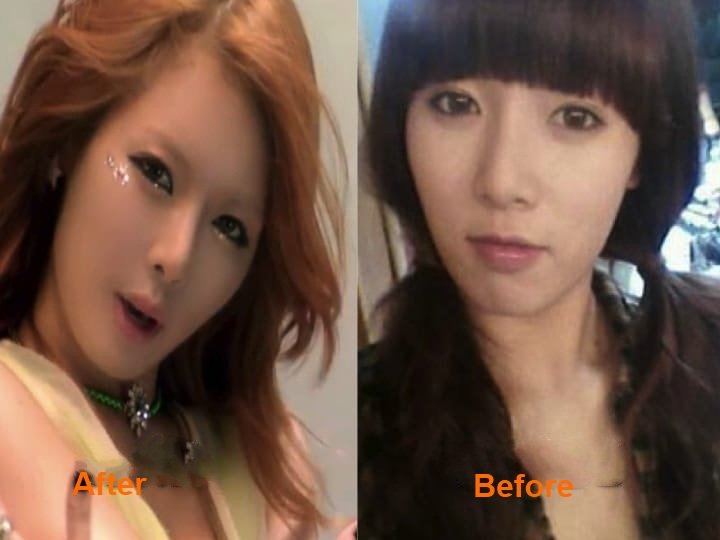 kim-hyuna-plastic-surgery-before-and-after-4-1