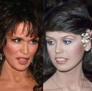 marie-osmond-plastic-surgery-before-and-after