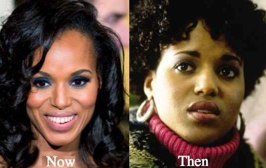 Kerry Washington before and after plastic surgery