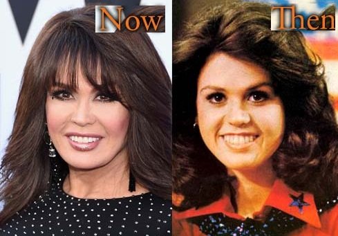  Marie Osmond before and after nose job