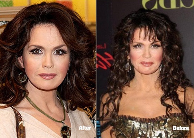 Marie Osmond before and after facelift