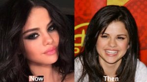  Selena Gomez is already using Botox