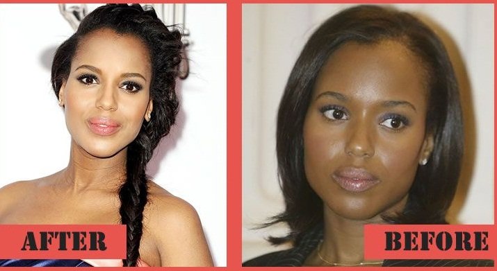 Kerry Washington before and after using Botox