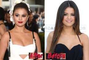 Selena Gomez before and after nose job