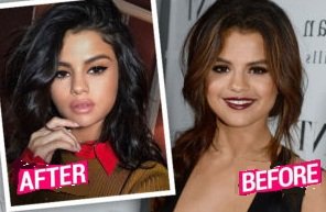 Selena Gomez has undergone the nose job