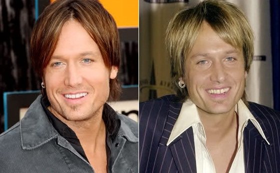 Keith Urban before and after facelift